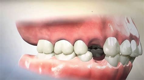 Removing Teeth For Braces What Happens During Extraction And Retraction Orthodontics Youtube