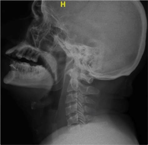 Normal Lateral X Ray Of The Neck On Admission Download Scientific Diagram
