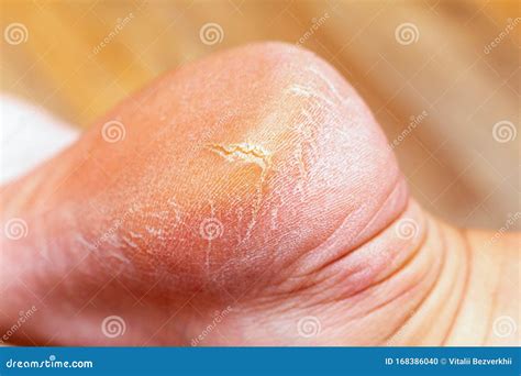 Corn Callus Cracks On A Sole Heel Foot Close Up Dry Skin Dermatology
