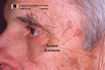 Actinic Keratosis: What is it? - Academic Dermatology of Nevada