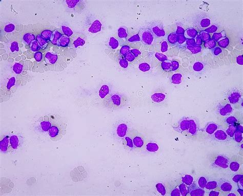 Acute Myeloid Leukemia Aml Smear Show Monocytes And Mostly Blast