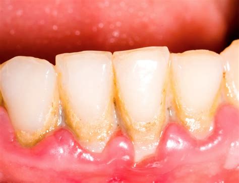 What Is Oral Cyst French Dental Services Drmiski Dubai