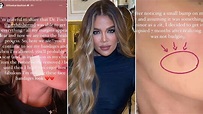 Khloé Kardashian reveals skin cancer scare, has tumour removed from her ...