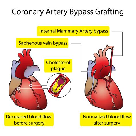 Coronary Artery Bypass Grafting Cabg Simplified Heart Sense