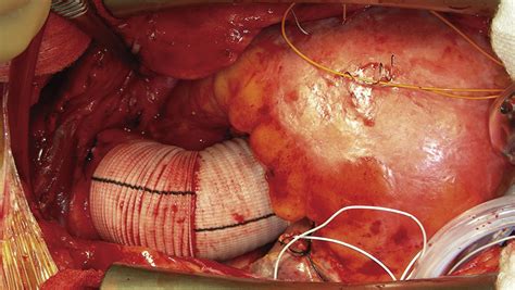 Aortoplasty For Management Of The Dilated Distal Ascending Aorta During