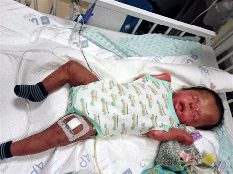 Jabari Gray San Antonio Baby Born Without Skin Finally Goes Home