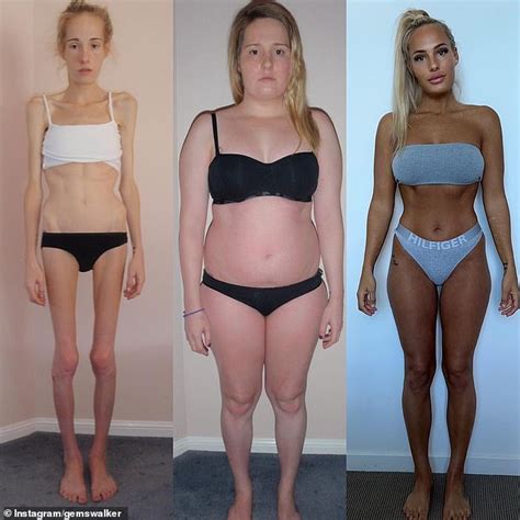 Surviving Anorexia Whose Weight Dropped To Just Pounds She
