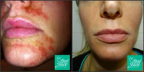 Face Burn Treatment Doctor Heck