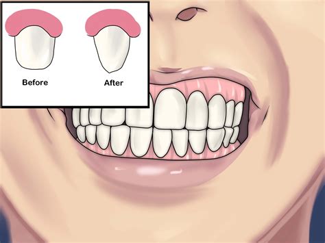 Get goodhow to set straight teeth without braces. How to Straighten Your Teeth Without Braces (with Pictures)