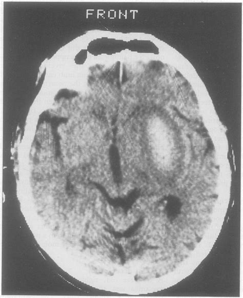 Ct Scan Showing A Large Haematoma Within The Right Basal Ganglia