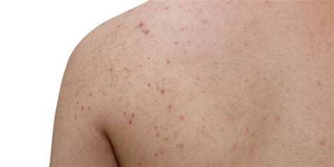 How To Get Rid Of Back Acne And Vitaman Usa