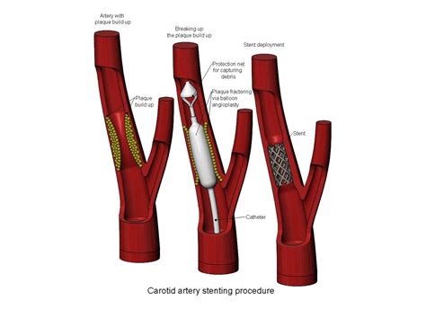 Carotid Artery Stenting Procedure Diorama 3D Print Model By RachidSW