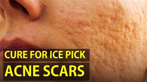How To Treat Ice Pick Acne Scars Youtube