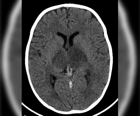 Thrombosis Of Internal Cerebral Veins A Cause Of Coma Figure 1