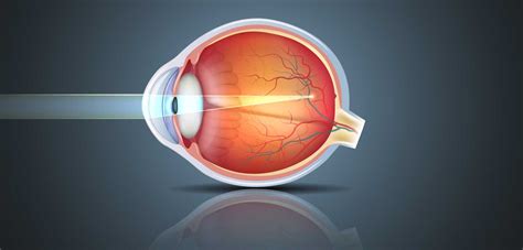 What Are The Different Types Of Myopia