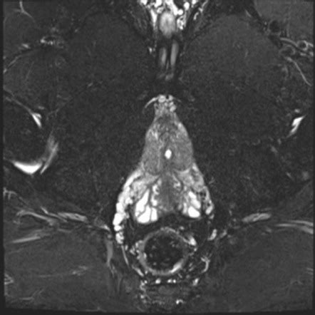 Perianal Fistula Protocol MRI Radiology Reference Article