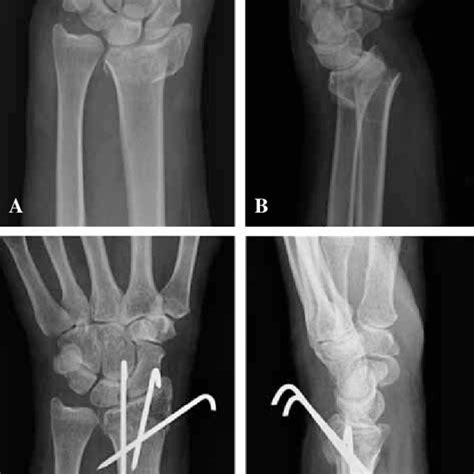 Distal Radius Fracture Treated With A Plate In A 66year Old Woman A