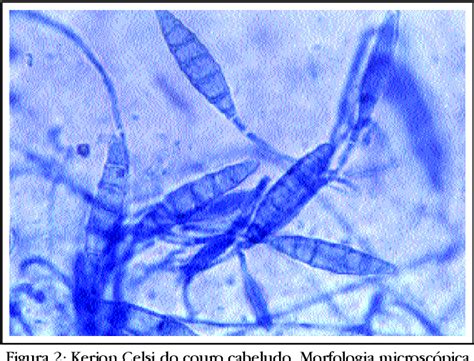 Figure 1 From Kerion Celsi Por Microsporum Gypseum Celsus Kerion
