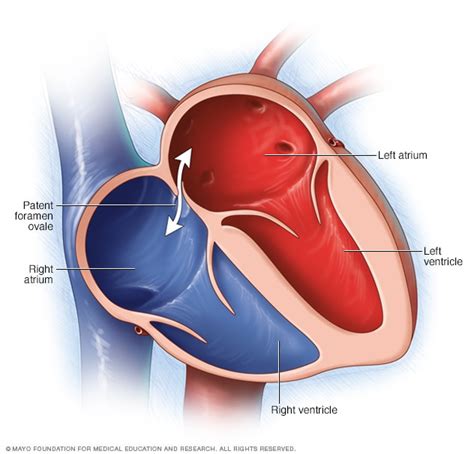 Patent Foramen Ovale Mayo Clinic