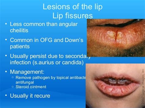 Lip Tongue Lesionsquick Summary