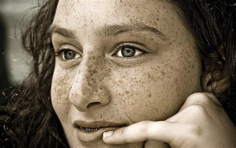 Freckles Moles And Birthmarks Dr Starbuck Explains Mtpr