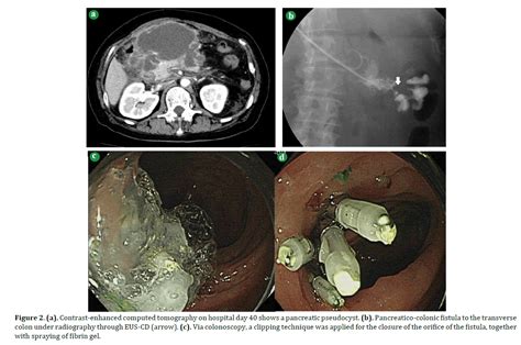 Pancreatico Colonic Fistula After Endoscopic Ultrasound Guided Cy
