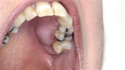 Kid With Abscess On Gum Dental Abscess In A Child Stock Image C008