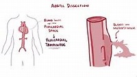 Aortic dissection - Wikipedia