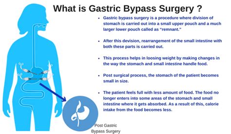 Gastric Bypass Surgery Overview And Complications