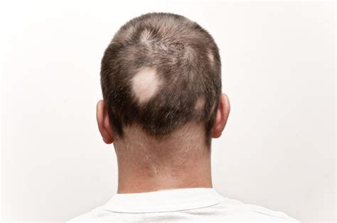 10 Causes Of Hair Loss RM Healthy
