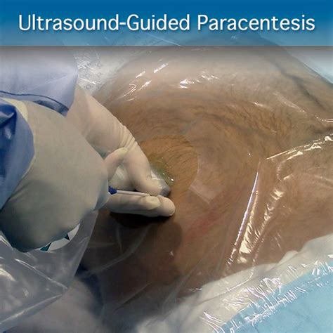 Ultrasound Guided Paracentesis Procedure Module Sonosim