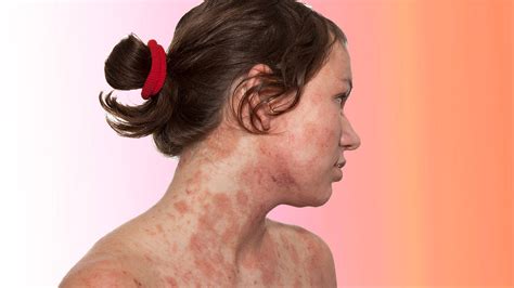 Dermatologist Shares Top Tips For Treating Eczema And Busts Myths