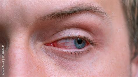 Close Up Irritated Infected Red Bloodshot Eyes Conjunctivitis