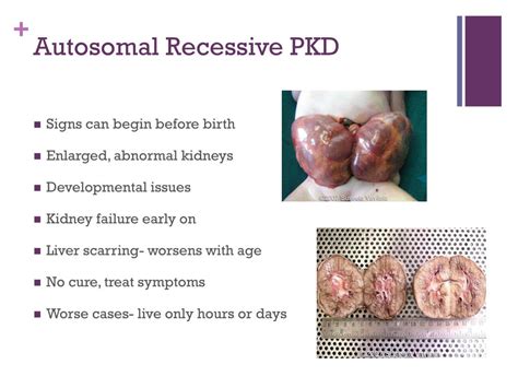 Ppt Polycystic Kidney Disease Powerpoint Presentation Free Download
