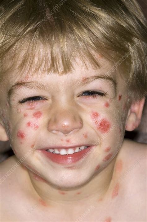 Psoriasis On The Face Stock Image C0029650 Science Photo Library