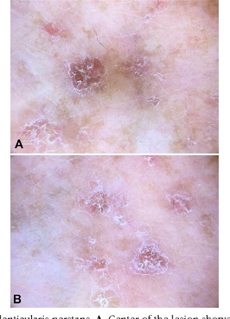 Figure 2 From Dermoscopic Findings In Hyperkeratosis Lenticularis