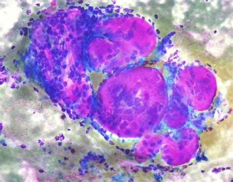 Speelselklier Adenoid Cysteus Carcinoom Electron Microscope Rocks