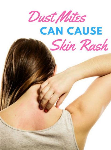 Pin On Eczema Itchy Skin And Allergy