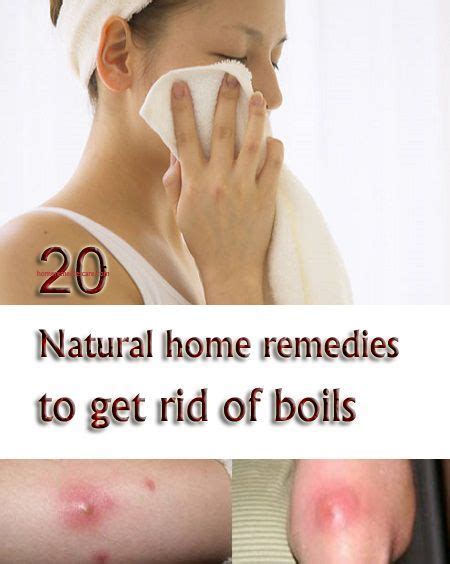 20 Natural Home Remedies To Get Rid Of Boils Natural Home Remedies