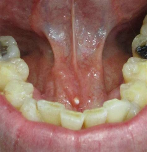 Why Is My Under Tongue Swollen Causes And Remedies