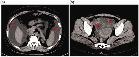 Spontaneous Ovarian Hyperstimulation Syndrome In A Nonpregnant Female