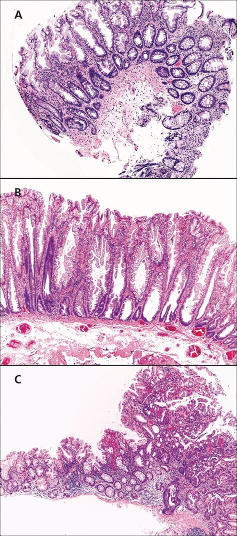 Sessile Serrated Polyps An Important Route To Colorectal Cancer In