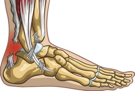 Achilles Tendon Rupture Frequently Asked Questions