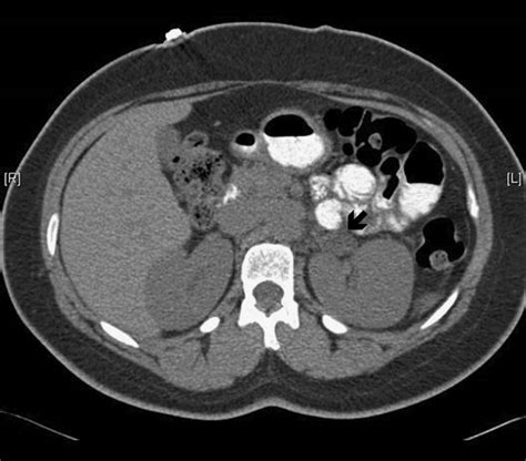 Adrenal Ct Scan Of Patient Show Left Adrenal Adenoma See Arrow