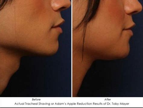 Adams Apple Reduction For Female Patients Ahb