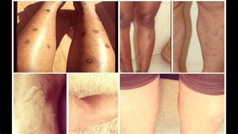 This can lead to bruising or the appearance of other dark spots. Detailed Guide on How To Treat Dark Spots On Legs(Fast ...