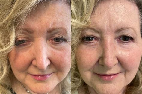 Nose Surgery Before And After Photos Patient 309 San Francisco Ca