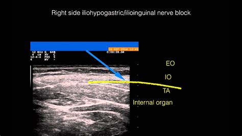 Ultrasound Guided Right Side Ilioinguinaliliohypogastric Nerve Block