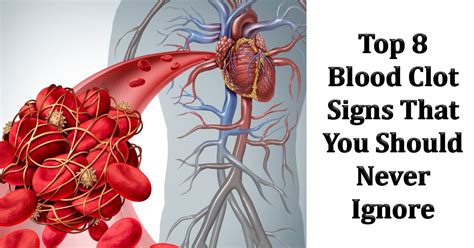 Top 8 Blood Clot Signs That Trigger Warning Whattolaugh