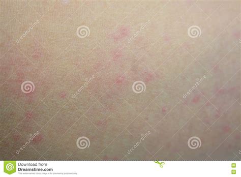 Ill Allergic Rash Dermatitis Eczema Skin Stock Image Image Of